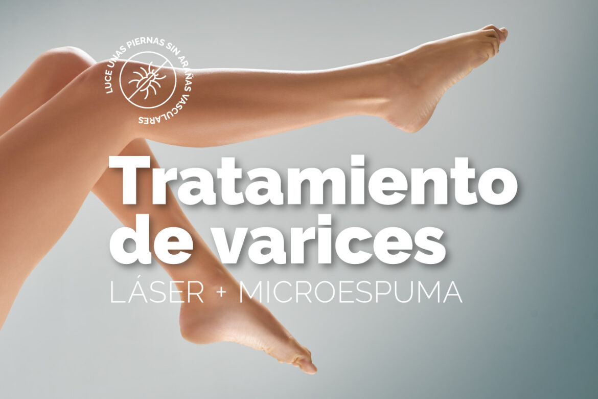 Tratamiento de varices